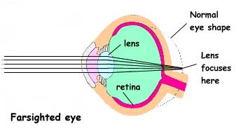 Farsighted