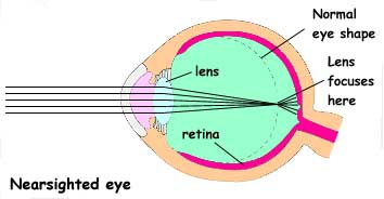 Nearsighted